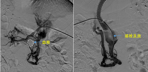 血栓攔路，如何破局——罕見巨大門靜脈血栓TIPS手術(shù)實錄