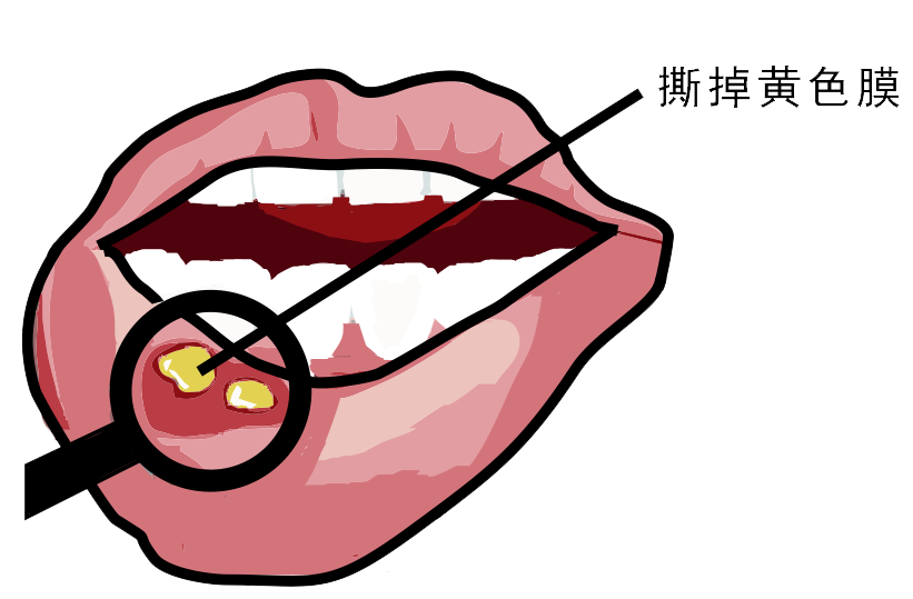 經(jīng)?？谇粷?，真的只是缺維生素嗎？