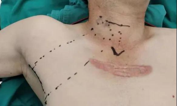 術(shù)后傷口可以“隱身”嗎？