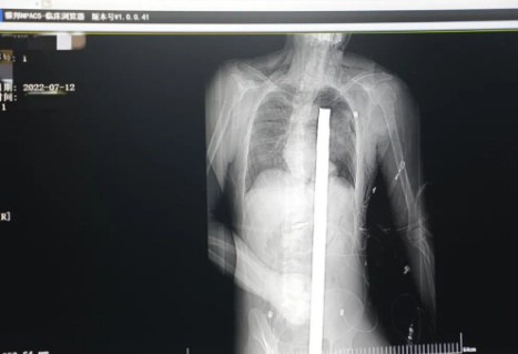 1.2米長的鋼筋貫穿男子胸腹！情況極度危險(xiǎn)......