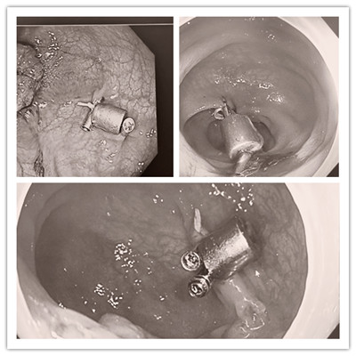 消化病醫(yī)院內外科聯合開展3例“磁環(huán)預標記輔助腹腔鏡結、直腸癌根治術”