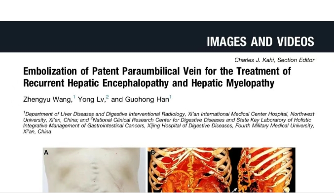 我院護理團隊臨床成果登榜國際肝病權(quán)威期刊，影響因子11.6